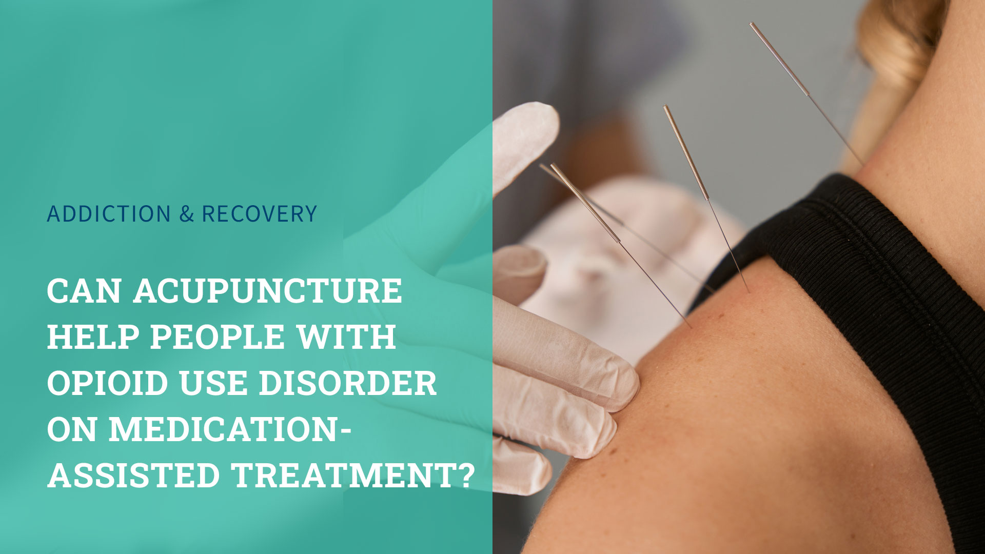 Can Acupuncture Help People with Opioid Use Disorder (OUD) on Medication-Assisted Treatment (MAT)?